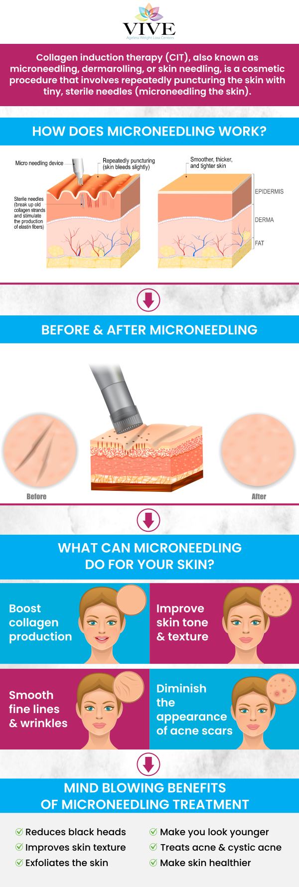 As we grow older, our skin loses its youthful appearance and elasticity. Microneedling reverses this process by increasing the body’s natural production of collagen. It helps in treating scars, large pores, wrinkles, and stretch marks. Rafael Olartecoechea at Vive Ageless Weight Loss Center provides successful microneedling treatments to address scars, wrinkles, acne, and other problems with immediate effects and low recovery on various kinds of skin. For more information contact us today or book an appointment online. We have convenient locations in Coral Gables FL, and Pinecrest FL.